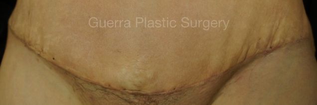 next Case #4201 Before