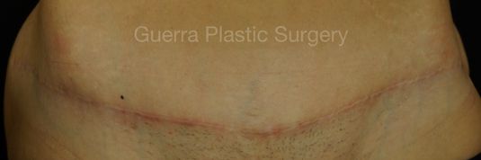 Case #4201 After