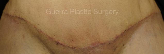 next Case #4202 Before
