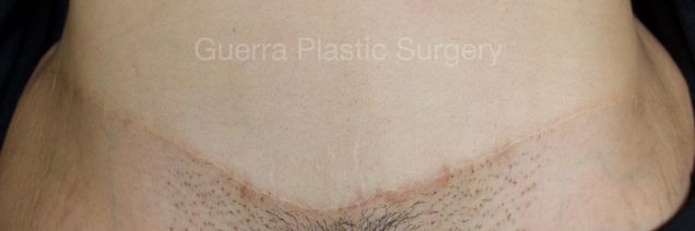 next Case #4202 After
