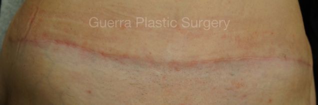 next Case #0403 After