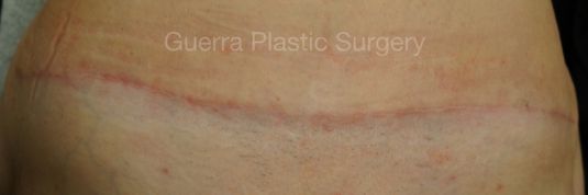 Case #0403 After