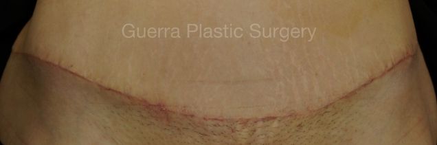 next Case #4204 Before