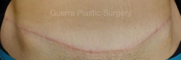 next Case #4204 After