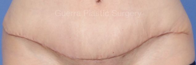next Case #4205 Before