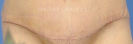 Case #4207 Before