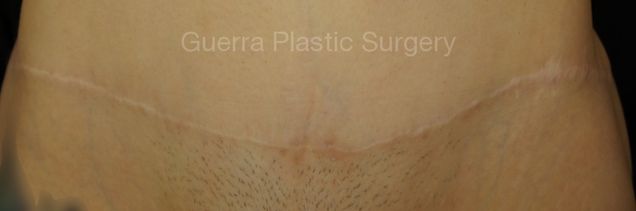 prev Case #4207 After