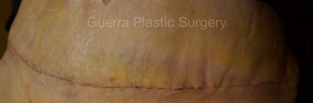prev Case #4206 Before