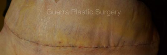 Case #4206 Before