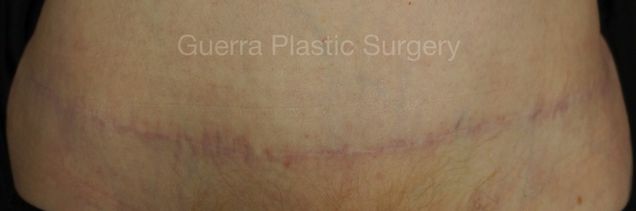 prev Case #4206 After