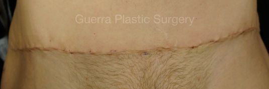 Case #4210 Before