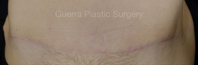 next Case #4210 After