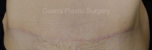 Case #4210 After