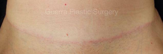 prev Case #4212 After