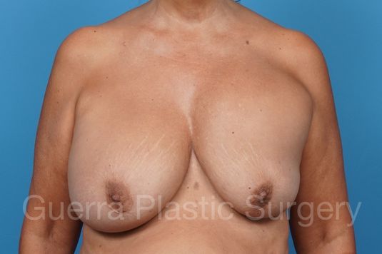 Case #38550 Before