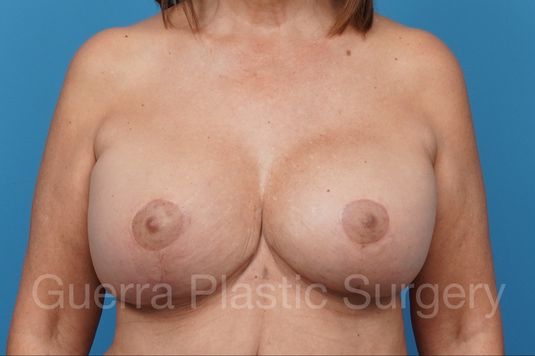 Case #38550 After