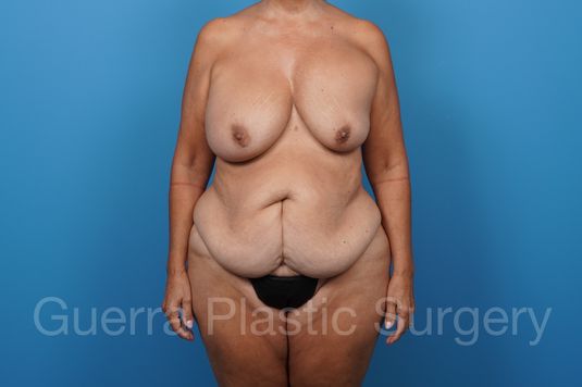 Case #38550 Before