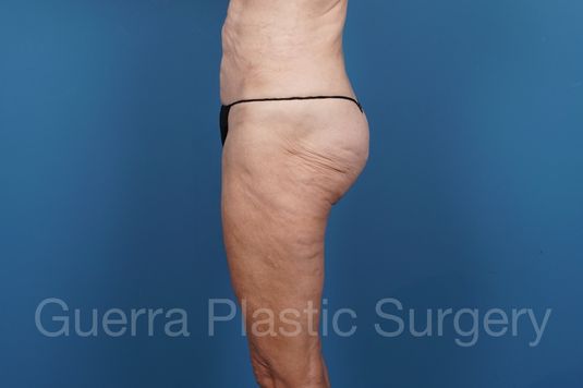modified spiral thigh lift actual patient before