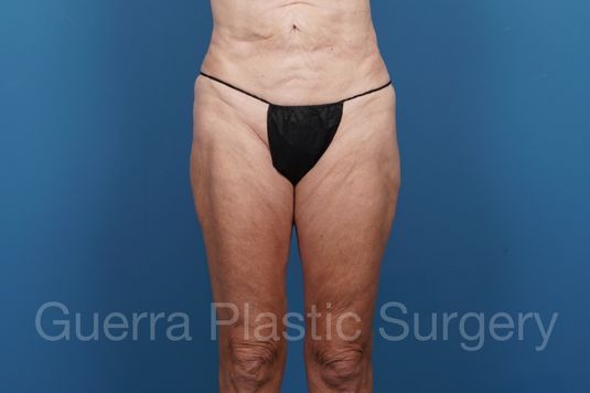 modified spiral thigh lift actual patient before