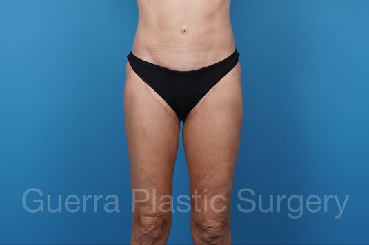 modified spiral thigh lift actual patient after