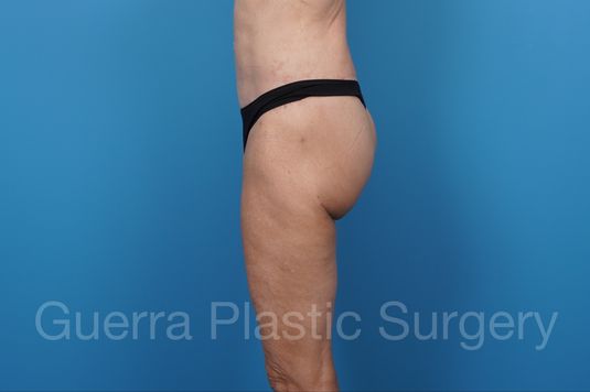 modified spiral thigh lift actual patient after