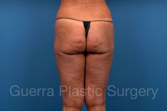 Before Photo Spiral Thigh Lift