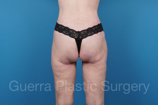 modified spiral thigh lift actual patient after