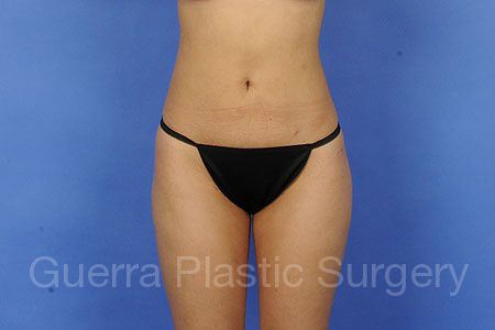 prev Case #93332 After