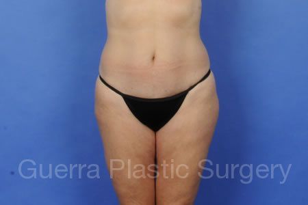 Case #30909 Before