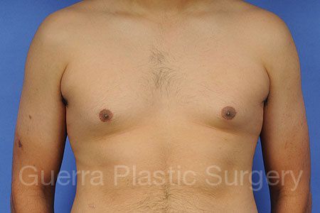 Case #36852 Before