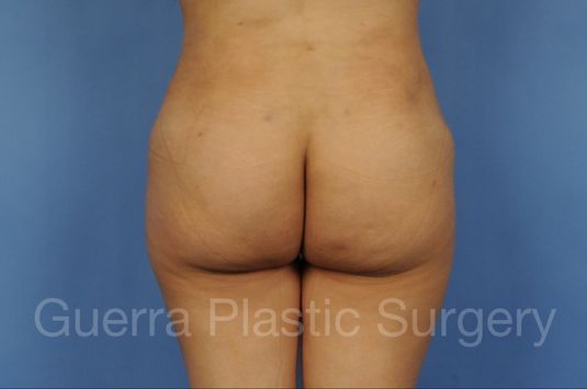 Case #17165 After