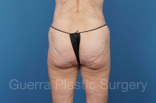 next Case #34686 Before