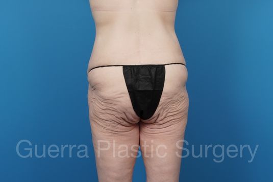 Before Photo Brazilian Butt Lift