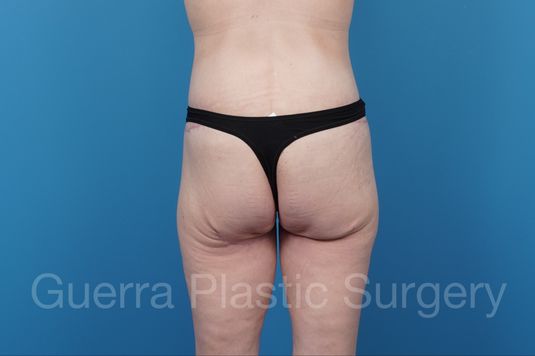 After Photo Brazilian Butt Lift
