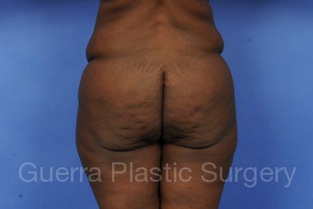 Case #35987 Before