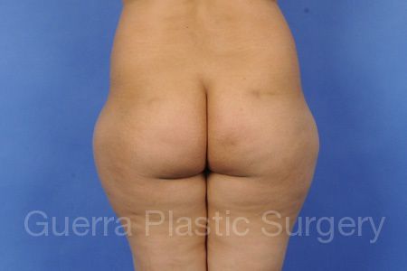 Case #86491 Before