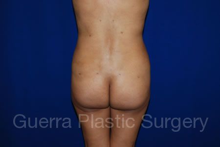 prev Case #26523 After