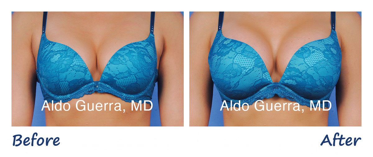 Breast Augmentation photos