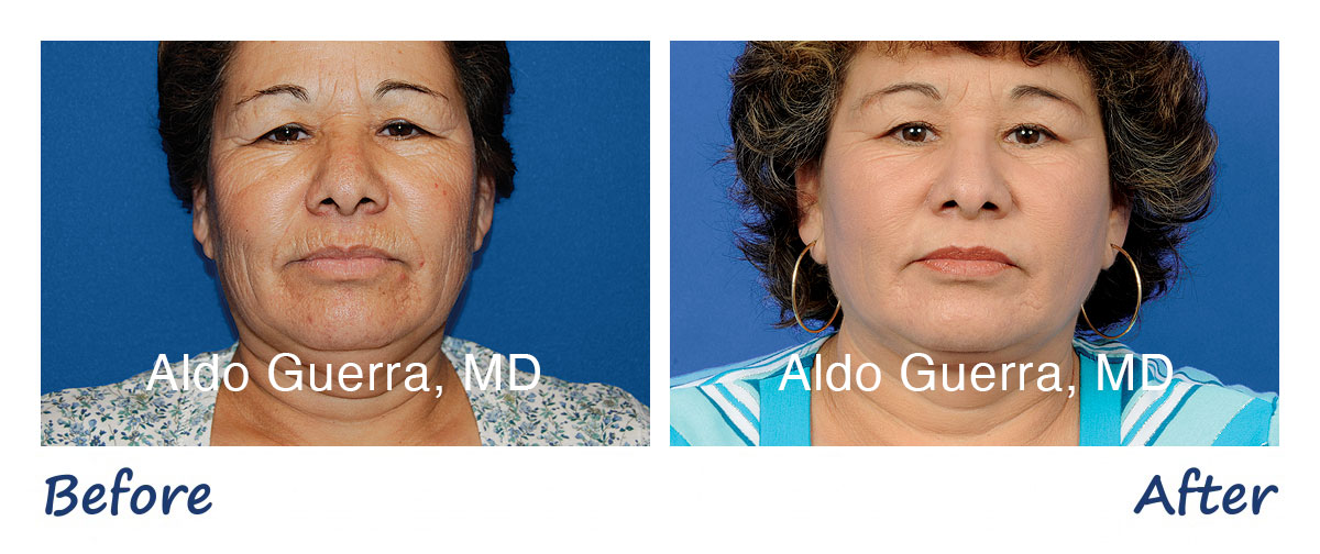 Before and After photo of actual patient - Eyelid Surgery